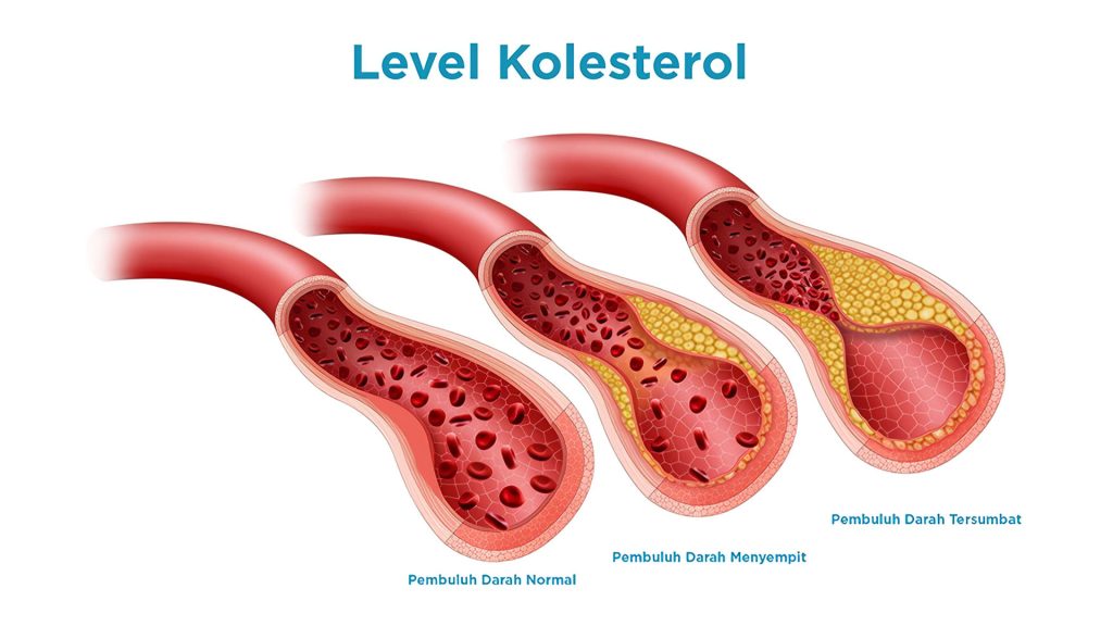 Kolesterol Tinggi: Penyebab dan Solusi Alami