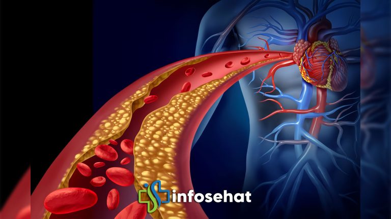 Kolesterol Tinggi: Penyebab dan Solusi Alami