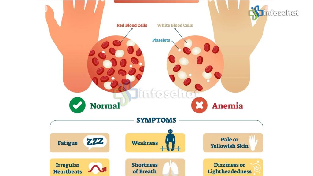 Anemia: Apa Itu dan Bagaimana Mengatasinya?