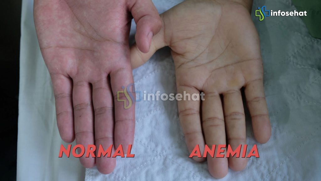 Anemia: Apa Itu dan Bagaimana Mengatasinya?