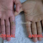 Anemia: Apa Itu dan Bagaimana Mengatasinya?