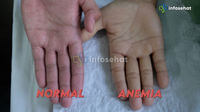 Anemia: Apa Itu dan Bagaimana Mengatasinya?