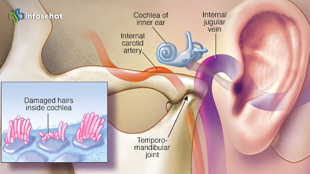 Tinnitus: Memahami Gejala dan Penyebab Telinga Berdenging