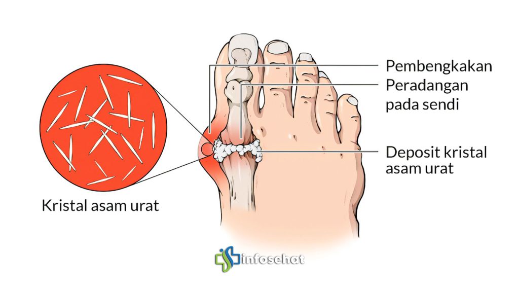 Asam Urat di Usia Muda: Penyebab dan Cara Menghindarinya