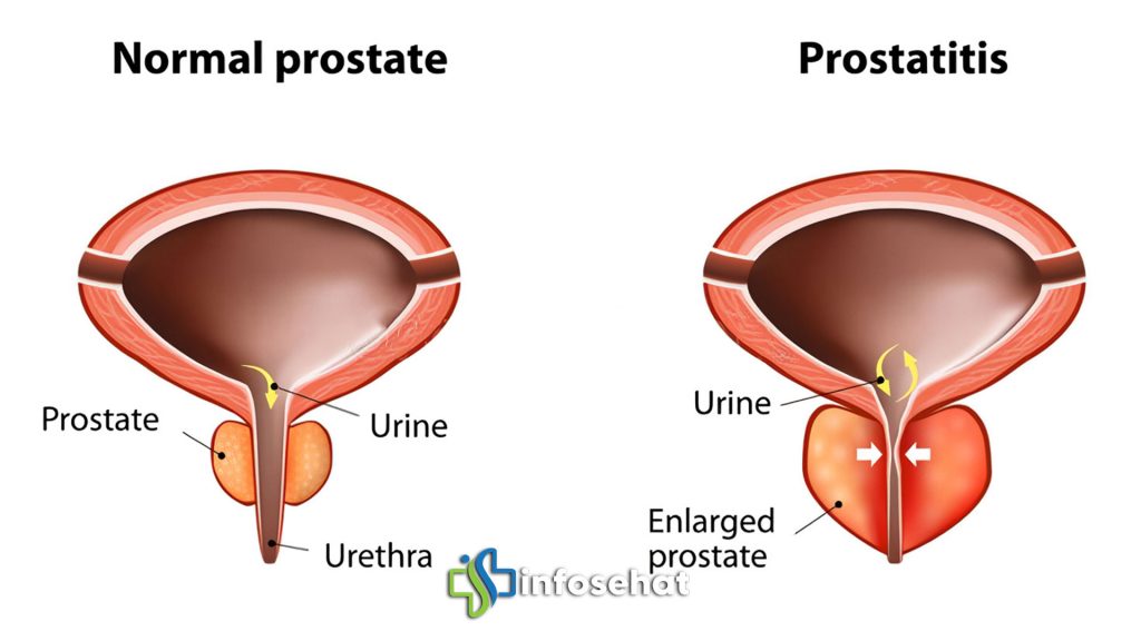  Penyakit Prostat: Gejala, Penyebab, dan Pengobatan