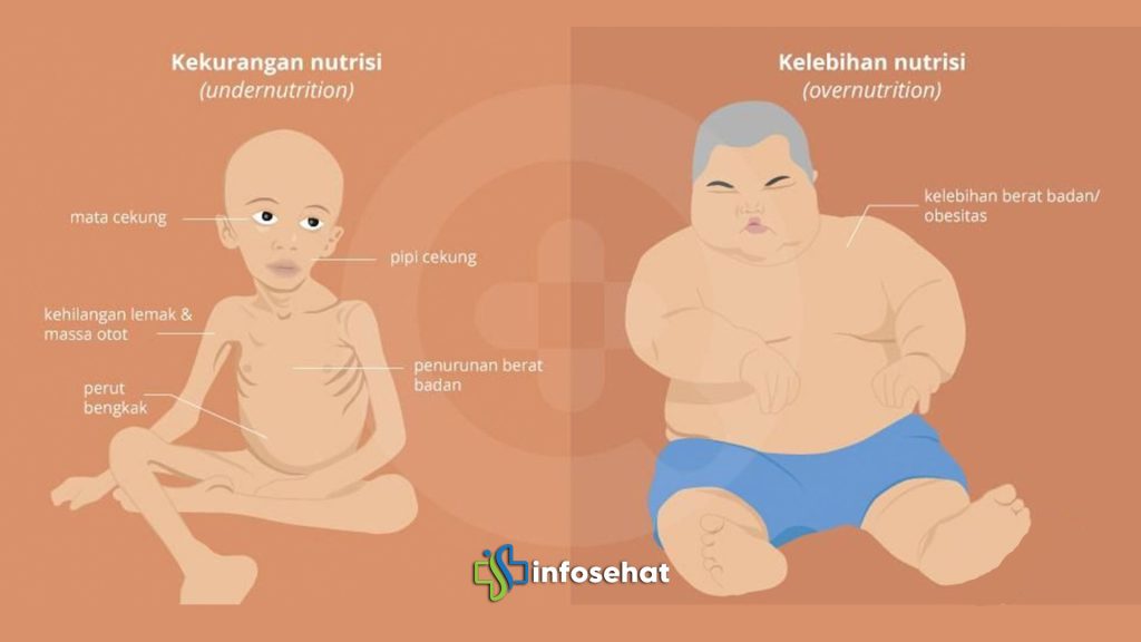 Malnutrisi pada Anak dan Dewasa: Gejala dan Solusi