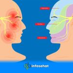 Neuralgia Trigeminal: Penyebab Nyeri Wajah yang Tak Terduga