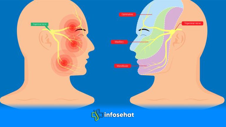 Neuralgia Trigeminal: Penyebab Nyeri Wajah yang Tak Terduga