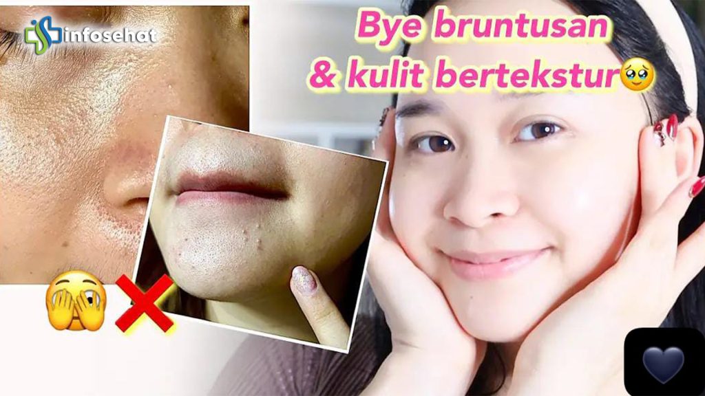 Tips Efektif Atasi Bruntusan di Jidat agar Kulit Lebih Halus