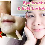 Tips Efektif Atasi Bruntusan di Jidat agar Kulit Lebih Halus