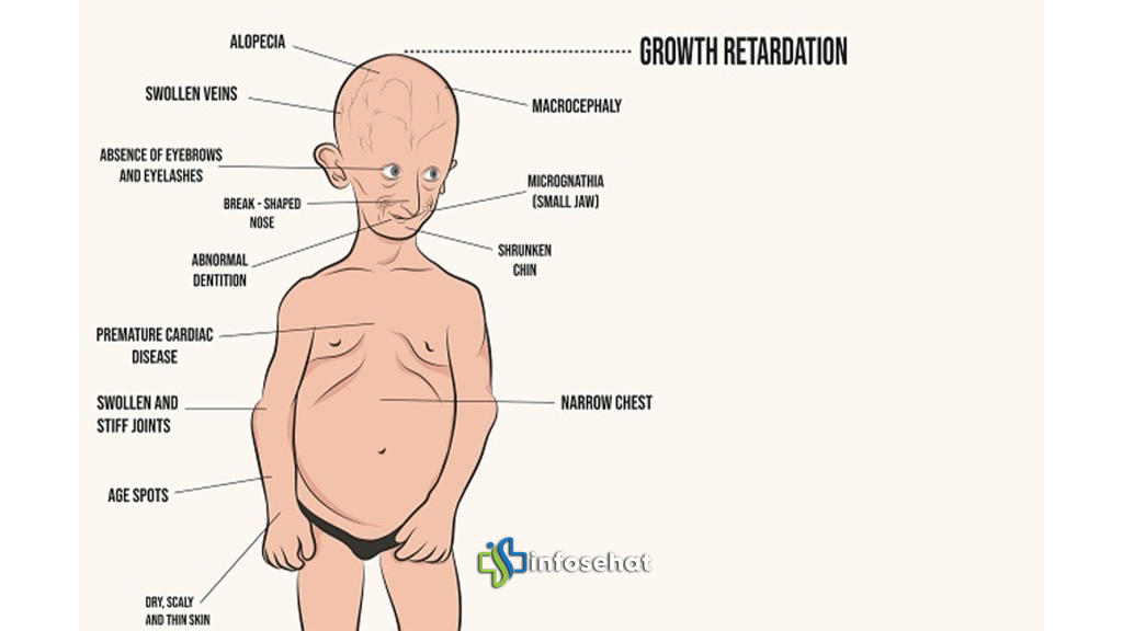 Progeria: Penuaan Dini Akibat Mutasi Gen LMNA